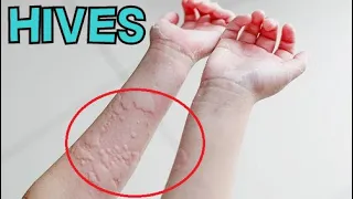 WHAT EXACTLY IS HIVES? - EXPLAINED IN 2 MINUTES