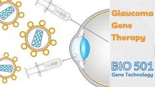 Glaucoma Gene Therapy - Possible but Not Any Time Soon