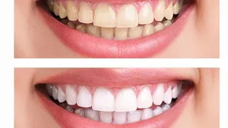 How to make dirty yellow teeth shiny in just 4 minutes! Teeth whitening