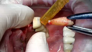 Сложное удаление зубов с фрагментированием | Upper teeth extraction | Тест камеры StarCam Full HD