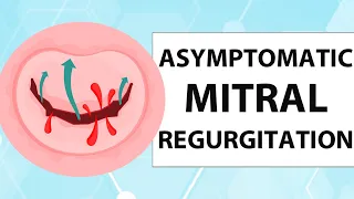 Asymptomatic Mitral Valve Regurgitation: Risks & Treatment with Dr. James Thomas