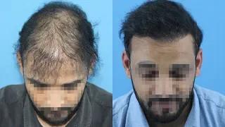 Day 1 To 8 Month Hair Transplant Journey,  3015 Grafts , @EugenixHairSciencesofficial By- Expert Surgeon