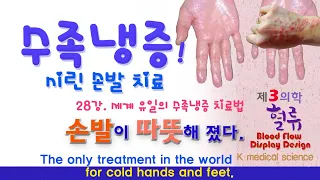 수족냉증 28강. 손발 냉증, 차가운 손과 발 시린 손발 유일한 치료법. The only treatment in the world for cold hands and feet.