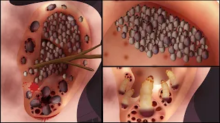 ASMR Treatment Animation Removal Of Dog Ticks | Ear Cleaning Animation | Universe 팅거 ASMR