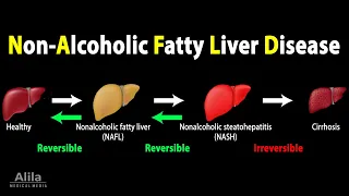 Nonalcoholic Fatty Liver Disease (NAFLD), Animation