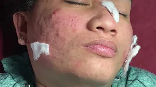 Acne Treatment Huong Da Nang#543  | 2023