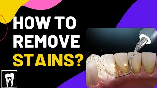 Dental Cleaning EXPLAINED | Stain & Tartar Removal | Black stain teeth