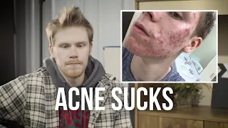 Acne Sucks