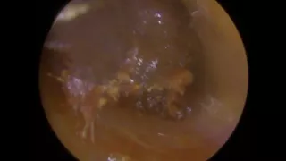 Entire Ear Canal Ear Wax Removal in Right Adult Ear - Ep 310
