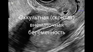 Оккультная (скрытая) внематочная беременность - случай диагностики с подробным описанием