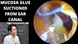 Middle Ear Glue Suctioned From Ear Canal