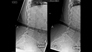 lecture spondylolisthesis 2021 may