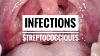 Infections à Streptocoque