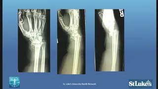 Distal radius fracture cases gone wrong - how to avoid and salvage problems