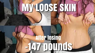 Loose Skin After Losing 147 lbs