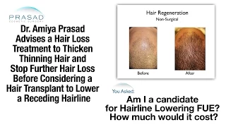 Best Solution for a Receding Hairline in Your 20s - Non-Surgical Treatment