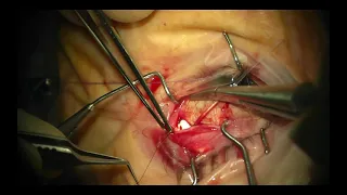 Tube Extension Techniques for Glaucoma Drainage Devices (Malik Y. Kahook, MD)