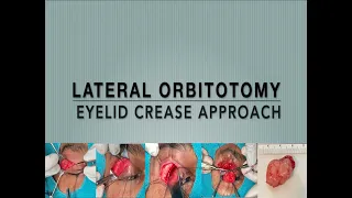 Lateral Orbitotomy via Eyelid Crease Approach: Dr Sonal Yadav