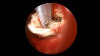 Endoscopic sinus surgery for maxillary sinus fungal ball