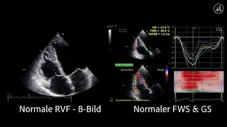 〖Echocardiografie〗Normaler Strain & normale RVF mit Fokus auf den rechten Ventrikel  📺🫀