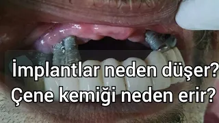 Diş implantları neden düşer? (Uzun dönem) İmplant etrafındaki kemik neden erir ?