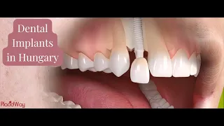 Dental Implants in Hungary for Your Confident Smile