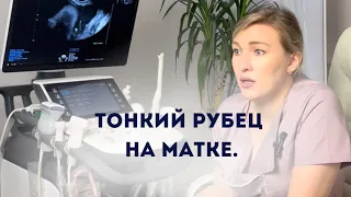 Тонкий рубец на матке.