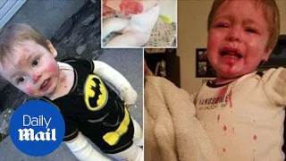 Boy has genetic disorder causing his skin to blister when touched