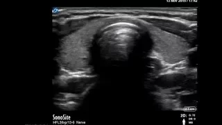 Ultrasound aided cricothyroid membrane identification