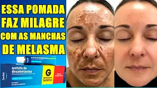 ACABE COM MELASMA E MANCHAS DE ACNE  EM POUCOS DIAS COM ESSA POMADA MILAGROSA