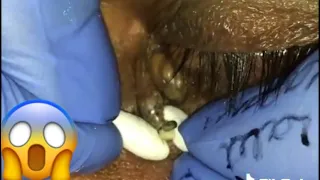Huge Old Pimples removed Near The Eye - Viewer Be Warned !