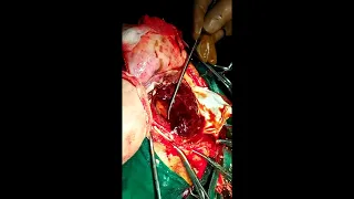 Craniotomy procedure for evacuation of Subdural Hematoma