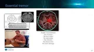 Focused Ultrasound and Parkinson's Disease