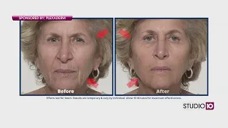 See Wrinkles Disappear with Plexaderm!