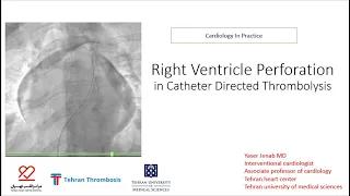 Right ventricle perforation in catheter directed thrombolysis (CDT) of pulmonary artery