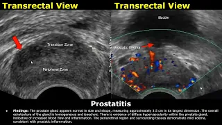 Prostate Ultrasound Reporting | BPH/Cancer/Cyst/Calcification Scan Reports | How To Write USG Report