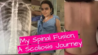 Spinal Fusion Vlog - Scoliosis Journey