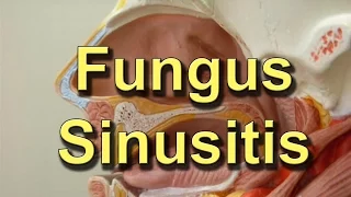 How To Get Rid Of Fungus In Your Sinus