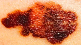 A Farmer Removed His Own Skin Cancer With A Pocket Knife! You Won`t Believe What Happened To His B