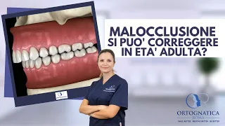 Malocclusioni dento-scheletriche: è possibile correggerle in età adulta?