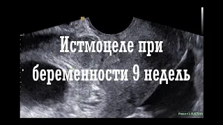 Истмоцеле в 9 недель беременности после двух кесаревых сечений