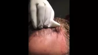 Repeat Hair Transplant for Maximum Density