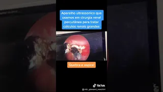 Cálculo Renal Cirurgia Percutânea