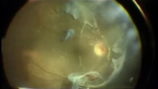 Chapter 10: Advanced proliferative diabetic retinopathy with detachment of posterior pole