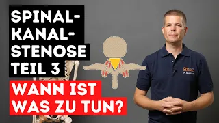 Spinalkanalstenose - Therapiereihenfolge - Was besonders wichtig ist - Teil 3