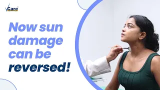 Sun damage is now reversible with Lactic Peel | Get rid of pigmentation | VCare | #skincare #vcare