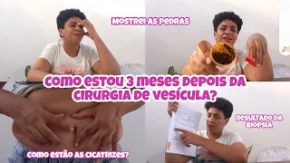 Como estou 3 meses depois da cirurgia de vesícula?