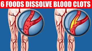 6 Foods That Dissolve Blood Clots Naturally