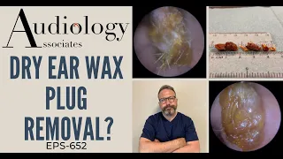 DRY EAR WAX PLUG REMOVAL - EP652