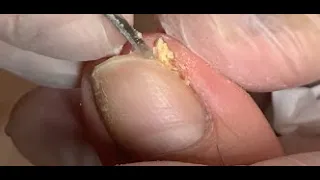 So much old skin under nail